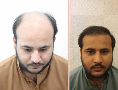 Before and after comparison