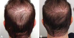 Before and after comparison